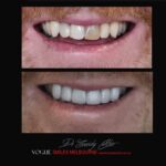 BLACK-TOOTH-DEAD-FRONT-TOOTH-MAKEOVERS-MELBOURNE-8-scaled.jpg