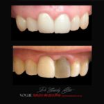 BLACK-TOOTH-DEAD-FRONT-TOOTH-MAKEOVERS-MELBOURNE-9-scaled.jpg