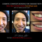 COSMETIC-BONDING-FOR-CROOKED-TEETH-MAKEOVERS-MELBOURNE-1.jpg