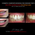 COSMETIC-BONDING-FOR-CROOKED-TEETH-MAKEOVERS-MELBOURNE-11.jpg