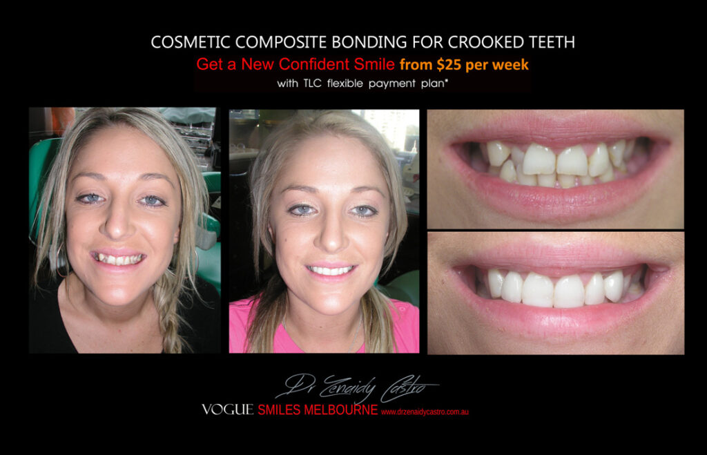 COSMETIC-BONDING-FOR-CROOKED-TEETH-MAKEOVERS-MELBOURNE-12.jpg