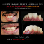 COSMETIC-BONDING-FOR-CROOKED-TEETH-MAKEOVERS-MELBOURNE-3.jpg