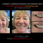 COSMETIC-BONDING-FOR-CROOKED-TEETH-MAKEOVERS-MELBOURNE-5.jpg