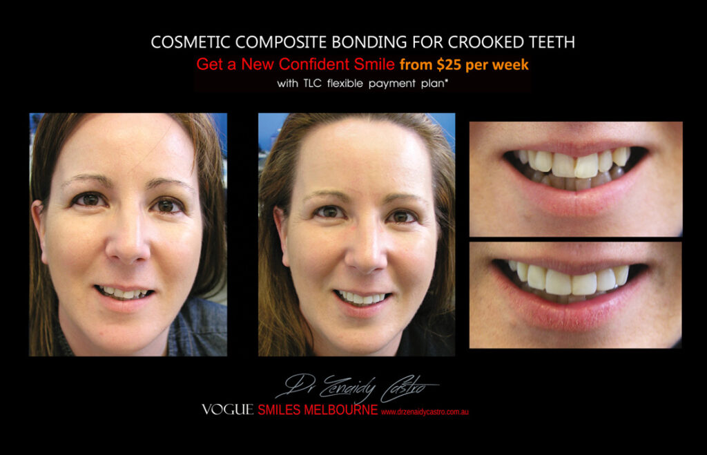 COSMETIC-BONDING-FOR-CROOKED-TEETH-MAKEOVERS-MELBOURNE-6.jpg