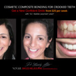 COSMETIC-BONDING-FOR-CROOKED-TEETH-MAKEOVERS-MELBOURNE-8.jpg