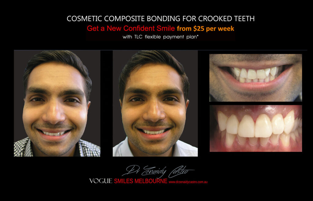 COSMETIC-BONDING-FOR-CROOKED-TEETH-MAKEOVERS-MELBOURNE-9.jpg