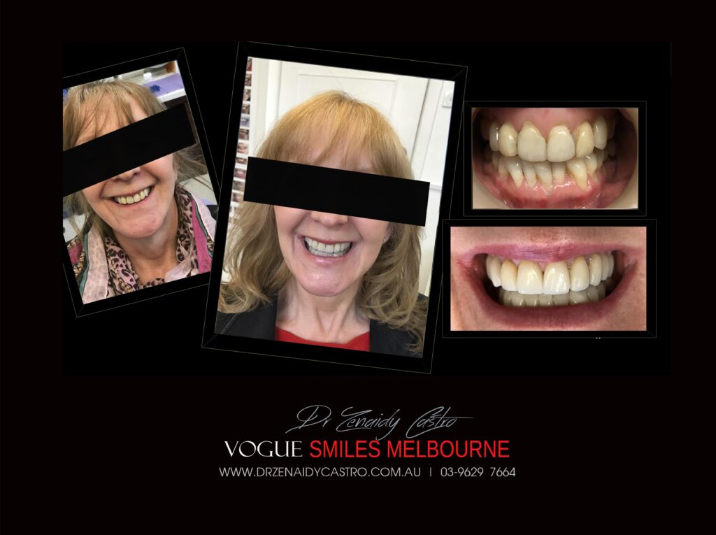 NARROW-SMILES-BROADENING-SMILES-MAKEOVERS-MELBOURNE-1-scaled.jpg