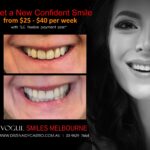 NARROW-SMILES-BROADENING-SMILES-MAKEOVERS-MELBOURNE-15-scaled.jpg