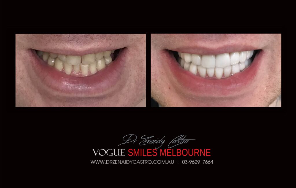 NARROW-SMILES-BROADENING-SMILES-MAKEOVERS-MELBOURNE-2-scaled.jpg