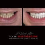 NARROW-SMILES-BROADENING-SMILES-MAKEOVERS-MELBOURNE-2-scaled.jpg