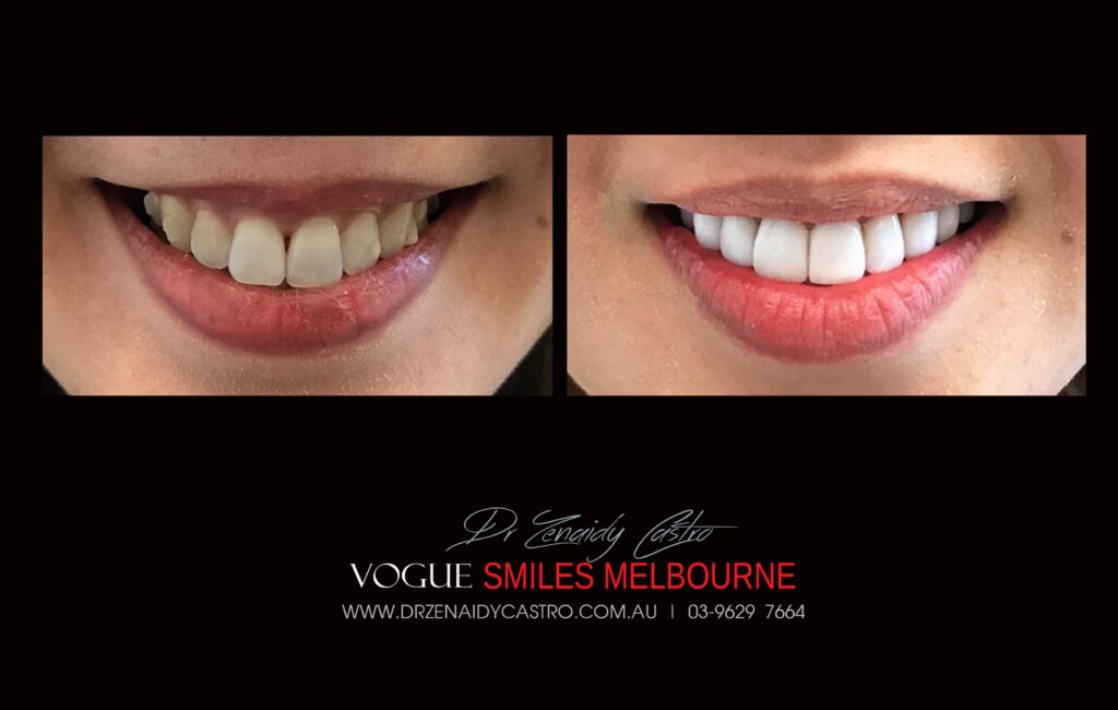 NARROW-SMILES-BROADENING-SMILES-MAKEOVERS-MELBOURNE-3-scaled.jpg