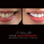 NARROW-SMILES-BROADENING-SMILES-MAKEOVERS-MELBOURNE-3-scaled.jpg