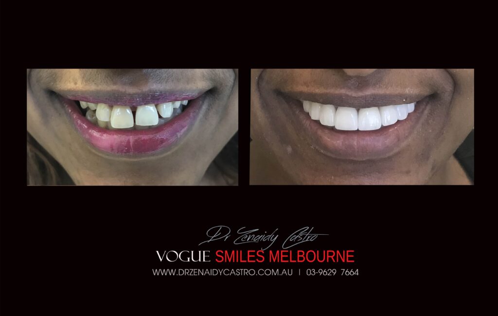 NARROW-SMILES-BROADENING-SMILES-MAKEOVERS-MELBOURNE-4-scaled.jpg