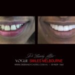 NARROW-SMILES-BROADENING-SMILES-MAKEOVERS-MELBOURNE-4-scaled.jpg