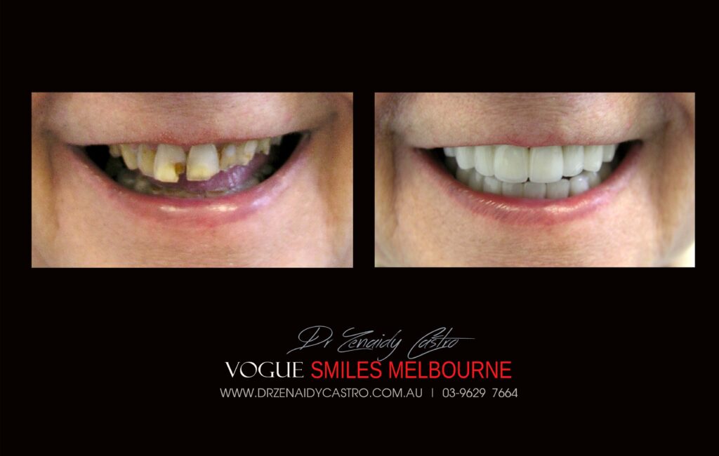 NARROW-SMILES-BROADENING-SMILES-MAKEOVERS-MELBOURNE-5-scaled.jpg