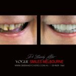 NARROW-SMILES-BROADENING-SMILES-MAKEOVERS-MELBOURNE-5-scaled.jpg