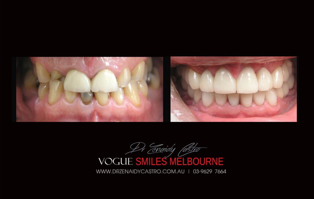 NARROW-SMILES-BROADENING-SMILES-MAKEOVERS-MELBOURNE-6-scaled.jpg