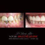 NARROW-SMILES-BROADENING-SMILES-MAKEOVERS-MELBOURNE-6-scaled.jpg