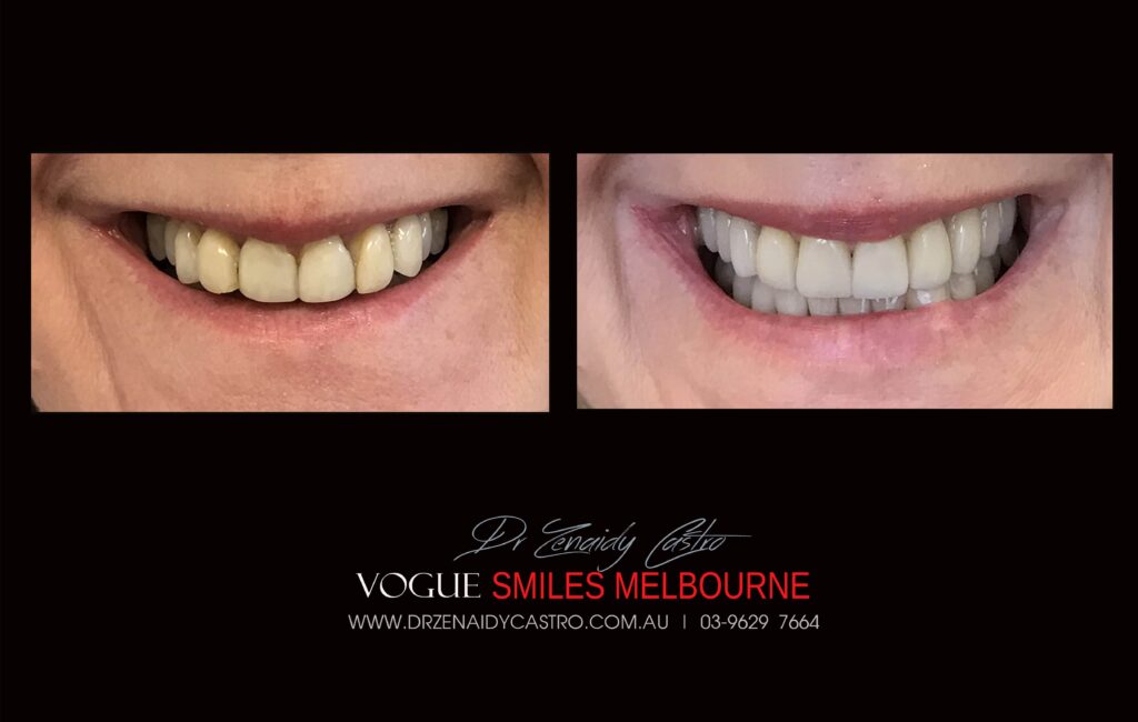 NARROW-SMILES-BROADENING-SMILES-MAKEOVERS-MELBOURNE-7-scaled.jpg