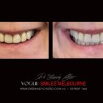 NARROW-SMILES-BROADENING-SMILES-MAKEOVERS-MELBOURNE-7-scaled.jpg