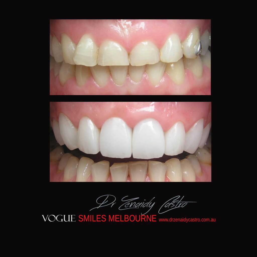 PORCELAIN-VENEERS-MAKEOVERS-MELBOURNE-11.jpg