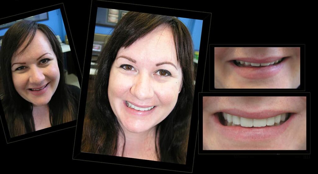 PORCELAIN-VENEERS-MAKEOVERS-MELBOURNE-14.jpg