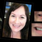 PORCELAIN-VENEERS-MAKEOVERS-MELBOURNE-14.jpg