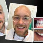 PREPLESS, NO GRINDING PORCELAIN VENEERS MELBOURNE CBD Smile Makeover gallery before and after- Cosmetic Dentist VOGUE SMILES MELBOURNE