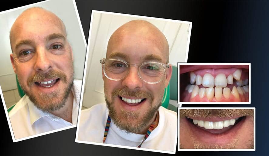 PREPLESS, NO GRINDING PORCELAIN VENEERS MELBOURNE CBD Smile Makeover gallery before and after- Cosmetic Dentist VOGUE SMILES MELBOURNE