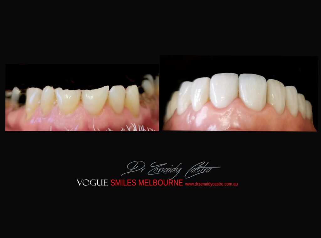 PREPLESS, NO GRINDING PORCELAIN VENEERS MELBOURNE CBD Smile Makeover gallery before and after- Cosmetic Dentist VOGUE SMILES MELBOURNE