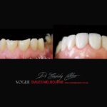 PREPLESS, NO GRINDING PORCELAIN VENEERS MELBOURNE CBD Smile Makeover gallery before and after- Cosmetic Dentist VOGUE SMILES MELBOURNE