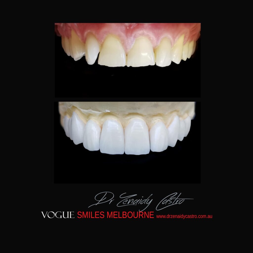 PREPLESS, NO GRINDING PORCELAIN VENEERS MELBOURNE CBD Smile Makeover gallery before and after- Cosmetic Dentist VOGUE SMILES MELBOURNE