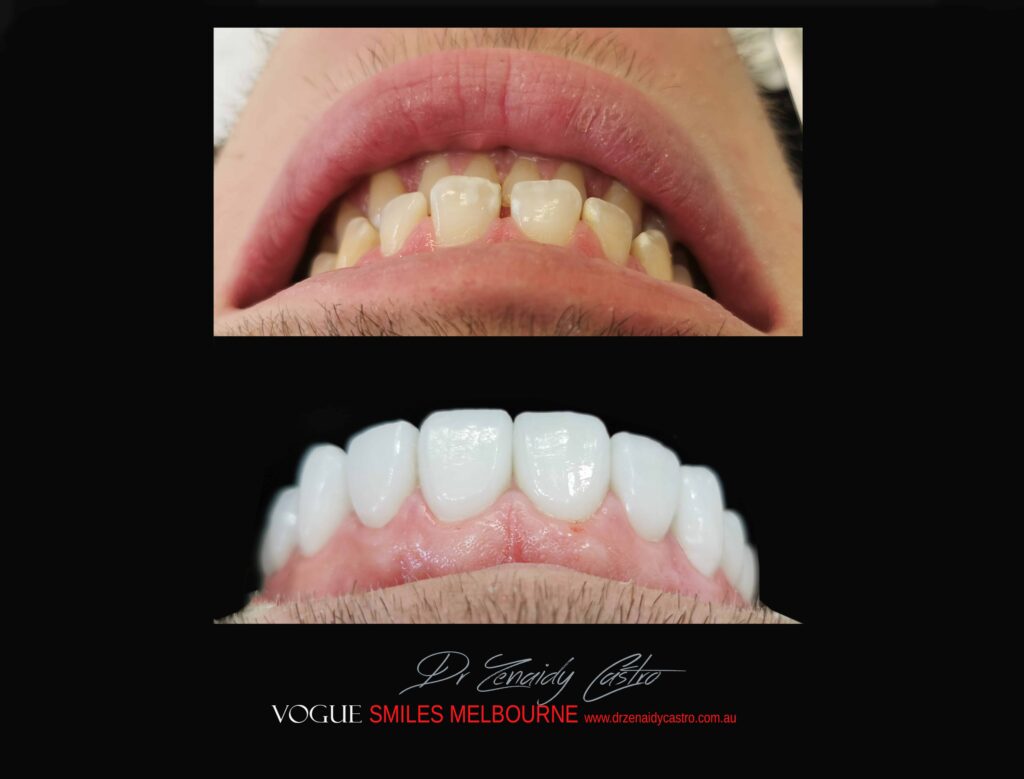 PORCELAIN-VENEERS-MAKEOVERS-MELBOURNE-2-scaled.jpg