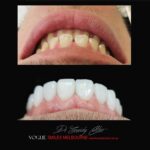 PORCELAIN-VENEERS-MAKEOVERS-MELBOURNE-2-scaled.jpg