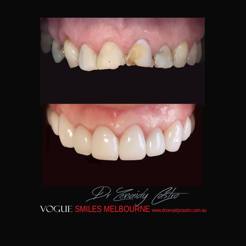 PREPLESS, NO GRINDING PORCELAIN VENEERS MELBOURNE CBD Smile Makeover gallery before and after- Cosmetic Dentist VOGUE SMILES MELBOURNE