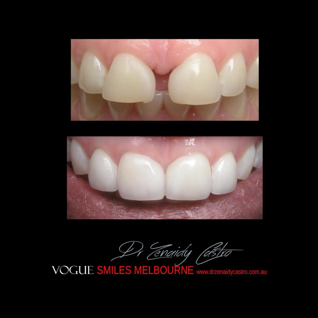 PREPLESS, NO GRINDING PORCELAIN VENEERS MELBOURNE CBD Smile Makeover gallery before and after- Cosmetic Dentist VOGUE SMILES MELBOURNE