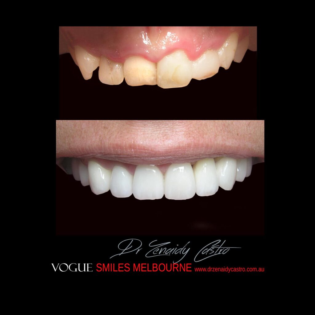 PREPLESS OR NO-GRINDING PORCELAIN VENEERS MELBOURNE CBD Smile Makeover gallery before and after- Cosmetic Dentist VOGUE SMILES MELBOURNE