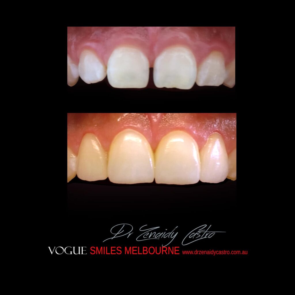 PREPLESS, NO GRINDING PORCELAIN VENEERS MELBOURNE CBD Smile Makeover gallery before and after- Cosmetic Dentist VOGUE SMILES MELBOURNE