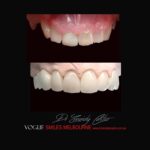 PREPLESS OR NO-GRINDING PORCELAIN VENEERS MELBOURNE CBD Smile Makeover gallery before and after- Cosmetic Dentist VOGUE SMILES MELBOURNE