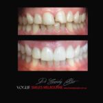 PORCELAIN-VENEERS-MAKEOVERS-MELBOURNE-3.jpg