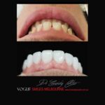 PREPLESS, NO GRINDING PORCELAIN VENEERS MELBOURNE CBD Smile Makeover gallery before and after- Cosmetic Dentist VOGUE SMILES MELBOURNE