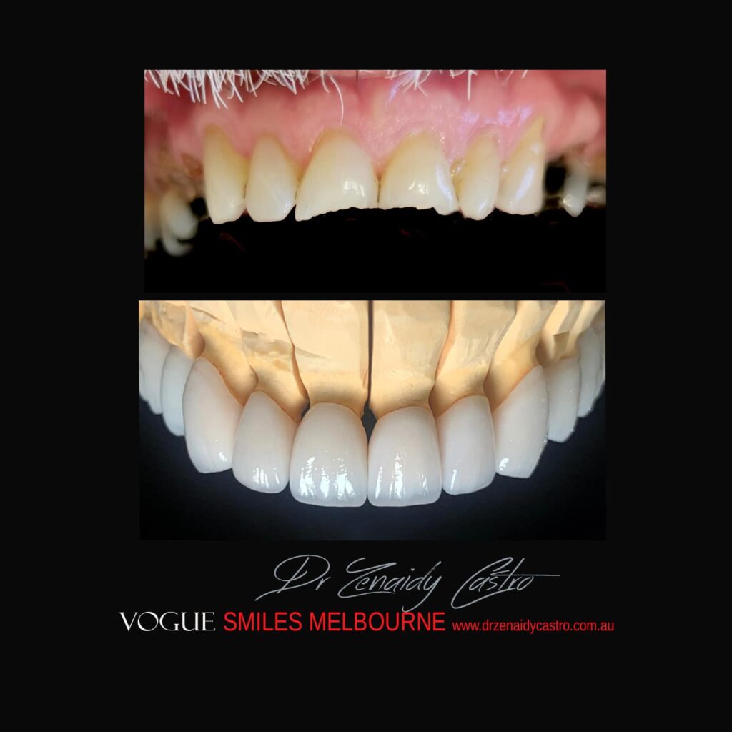 PREPLESS, NO GRINDING PORCELAIN VENEERS MELBOURNE CBD Smile Makeover gallery before and after- Cosmetic Dentist VOGUE SMILES MELBOURNE