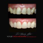 PREPLESS OR NO-GRINDING PORCELAIN VENEERS MELBOURNE CBD Smile Makeover gallery before and after- Cosmetic Dentist VOGUE SMILES MELBOURNE