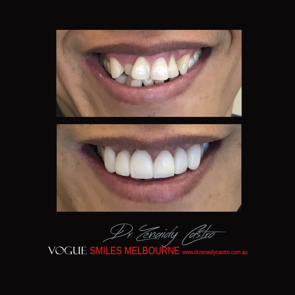 PREPLESS, NO GRINDING PORCELAIN VENEERS MELBOURNE CBD Smile Makeover gallery before and after- Cosmetic Dentist VOGUE SMILES MELBOURNE