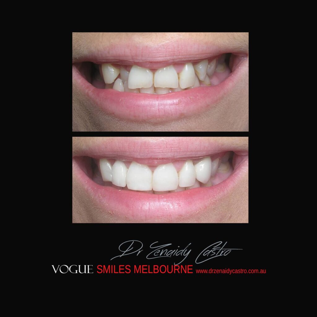 PREPLESS, NO GRINDING PORCELAIN VENEERS MELBOURNE CBD Smile Makeover gallery before and after- Cosmetic Dentist VOGUE SMILES MELBOURNE