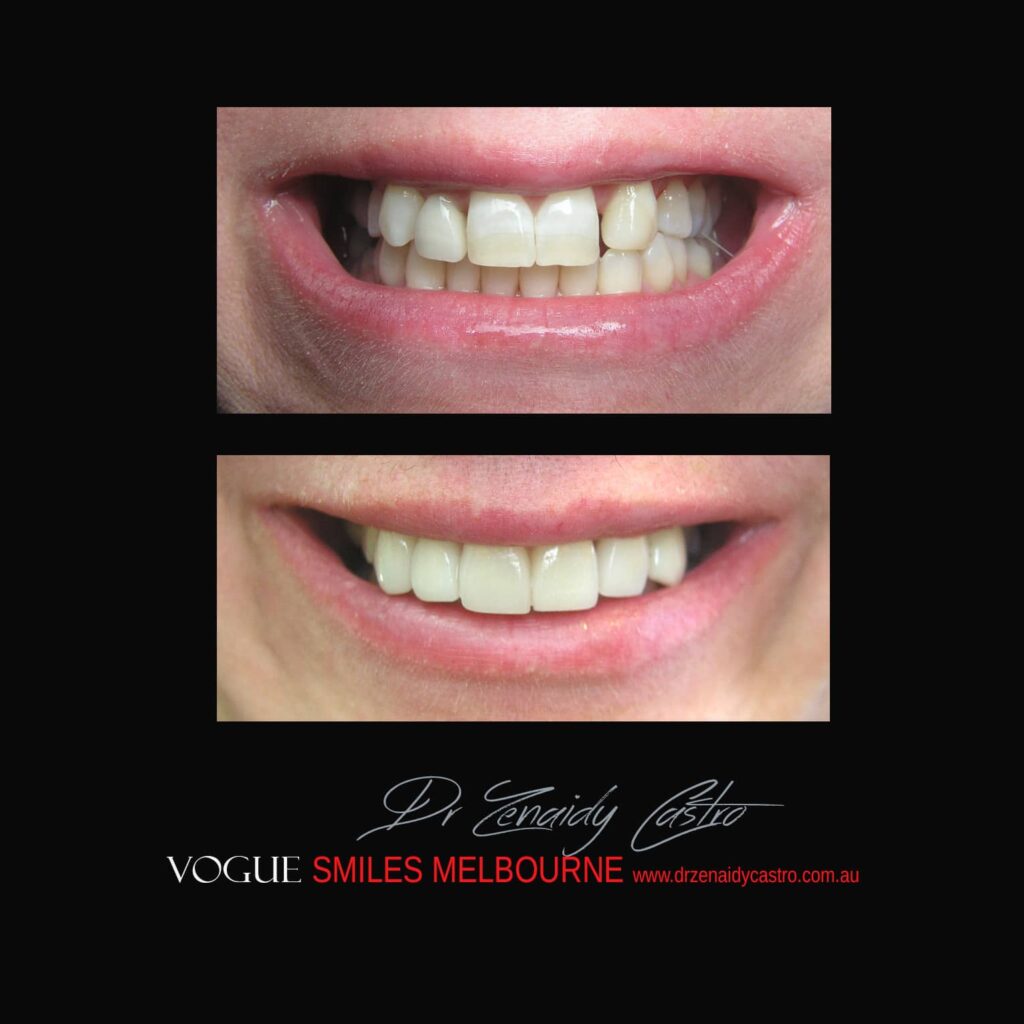 PREPLESS OR NO-GRINDING PORCELAIN VENEERS MELBOURNE CBD Smile Makeover gallery before and after- Cosmetic Dentist VOGUE SMILES MELBOURNE