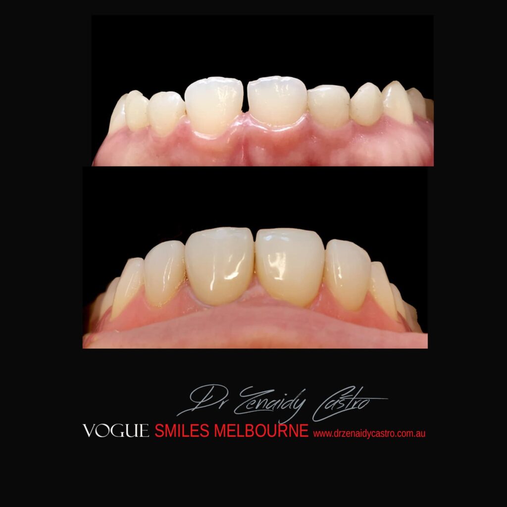 PREPLESS, NO GRINDING PORCELAIN VENEERS MELBOURNE CBD Smile Makeover gallery before and after- Cosmetic Dentist VOGUE SMILES MELBOURNE