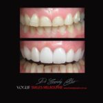 PORCELAIN-VENEERS-MAKEOVERS-MELBOURNE-4.jpg