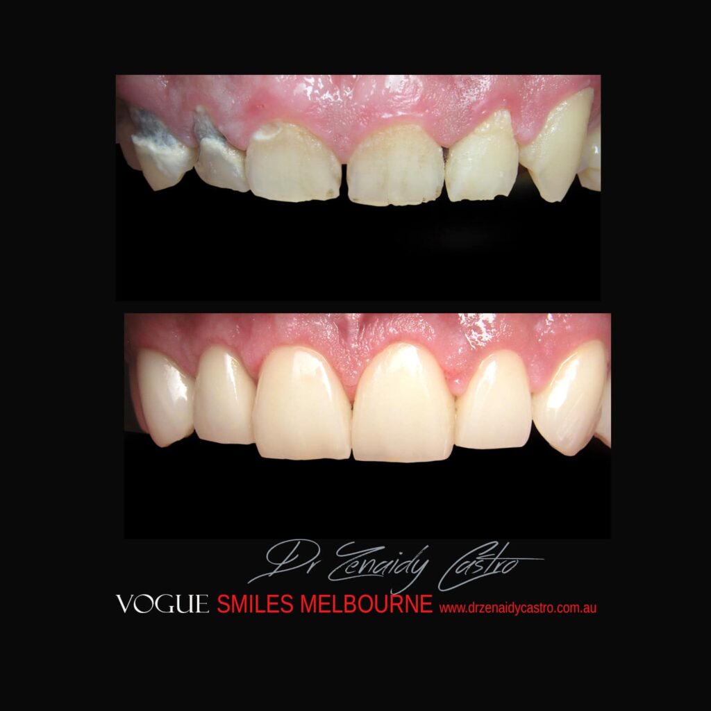 PREPLESS, NO GRINDING PORCELAIN VENEERS MELBOURNE CBD Smile Makeover gallery before and after- Cosmetic Dentist VOGUE SMILES MELBOURNE