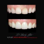 PORCELAIN-VENEERS-MAKEOVERS-MELBOURNE-41.jpg